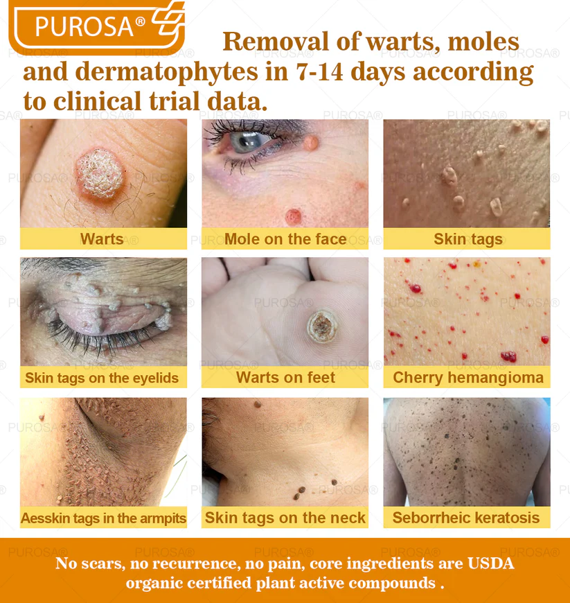 🐝PUROSA® Bee Venom Skin Treatment Cream, Anti-aging, Hydrating, Skin Repair, Even Tone, Acne and Dark Spot Treatment, Wart and Mole Removal, Psoriasis Relief