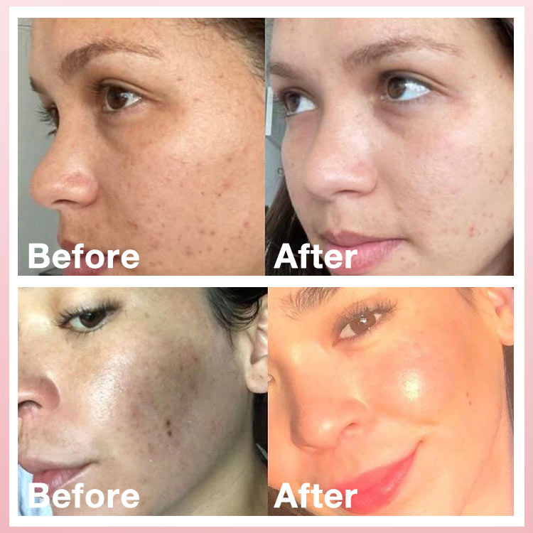 Whitening Cream-Gently fades peels dark spots to revealmore even &amp;brighter skin
