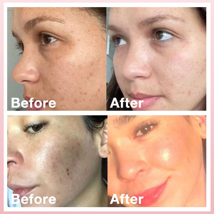 Whitening Cream-Gently fades peels dark spots to revealmore even &amp;brighter skin