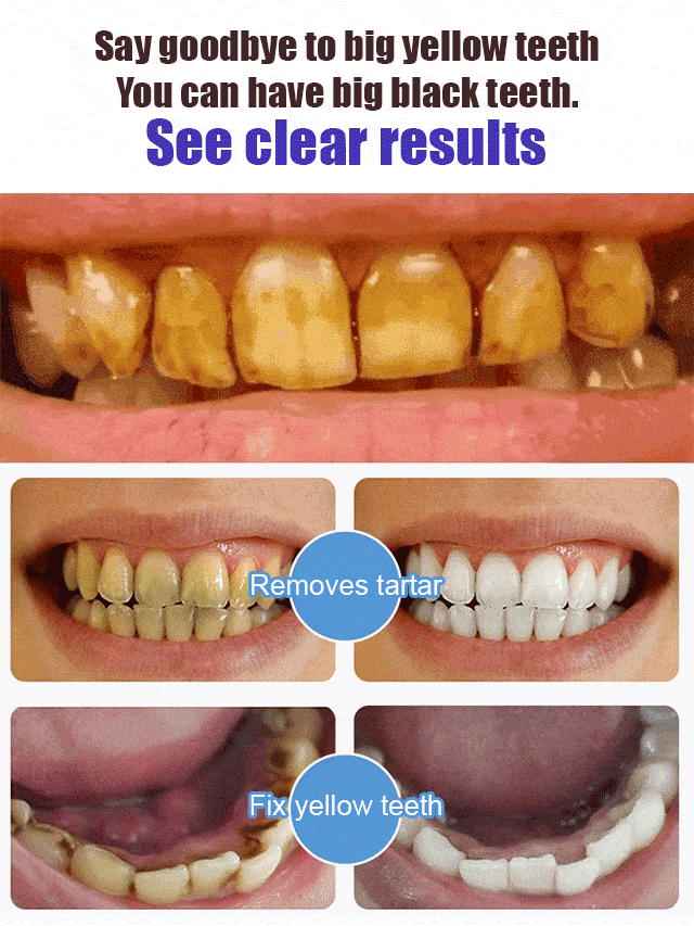 💥2024 Experts Recommend Product-Fresh Whitening Probiotic Toothpaste