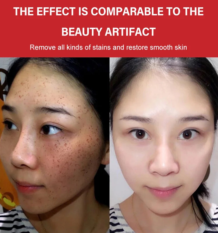 BRIGHTENING FRECKLE CREAM-BUY 2 GET 1 FREE💥