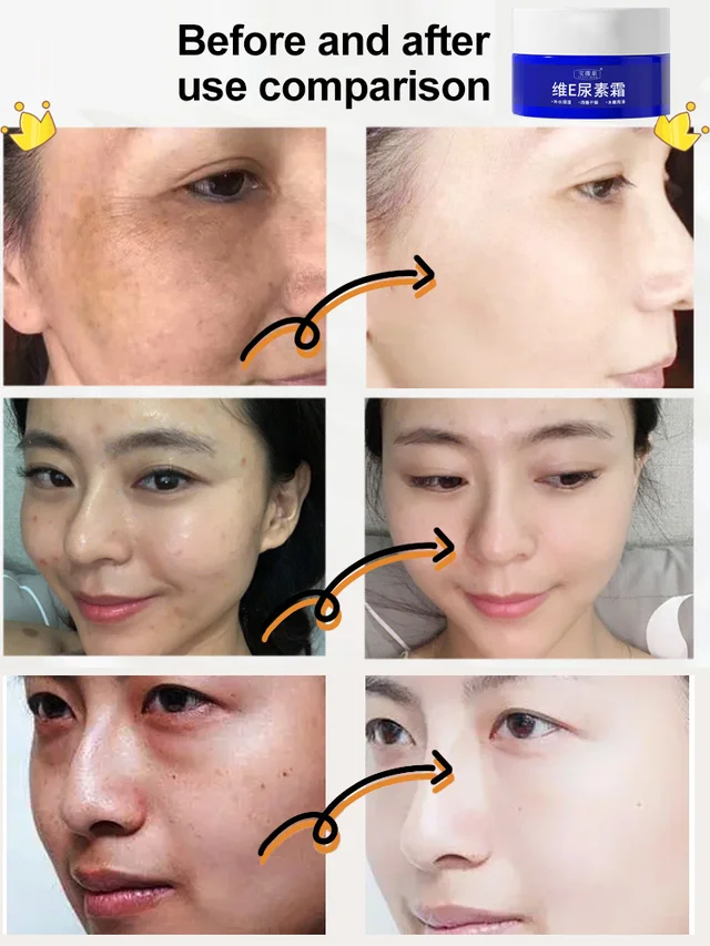 🎁2025 Hot Sale🎁Spot Fading Urea Cream