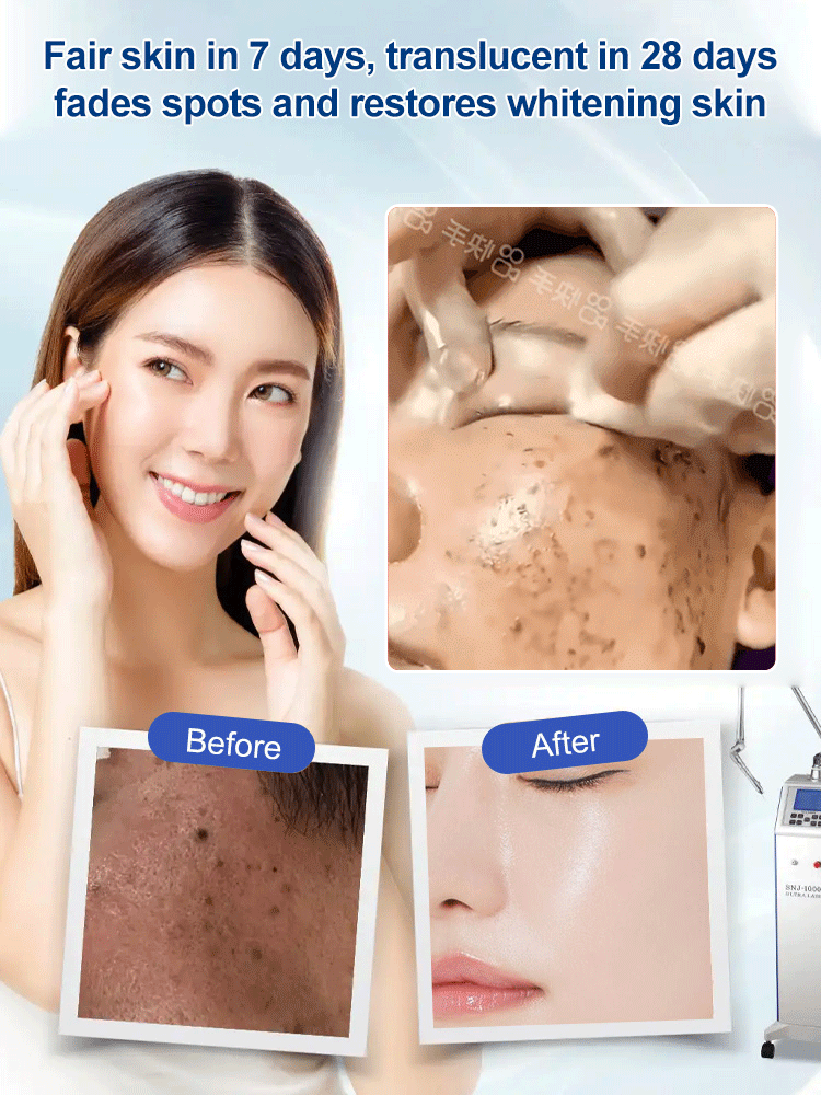 🎁2025 Hot Sale🎁Spot Fading Urea Cream