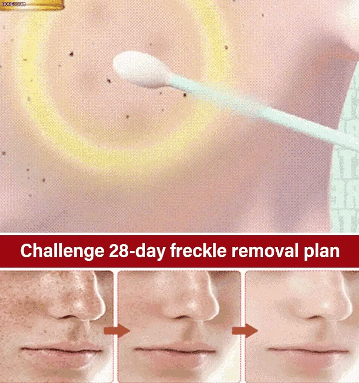 BRIGHTENING FRECKLE CREAM-BUY 2 GET 1 FREE💥
