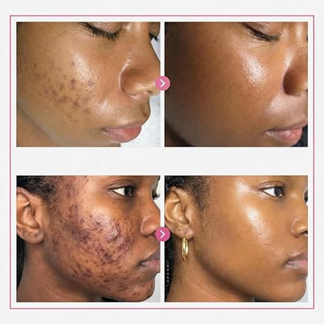 🔥Limited Time Offer🔥Tranexamic Acid Cream for Face &amp; Body