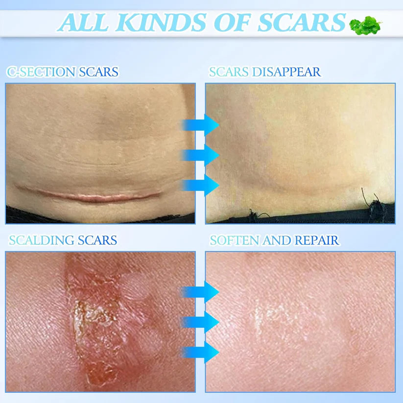 🔥Limited Time Offer🔥Skin Smoothing Scar Cream, Lighten &amp; Repair All Scars