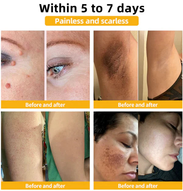 🐝PUROSA® Bee Venom Skin Treatment Cream, Anti-aging, Hydrating, Skin Repair, Even Tone, Acne and Dark Spot Treatment, Wart and Mole Removal, Psoriasis Relief