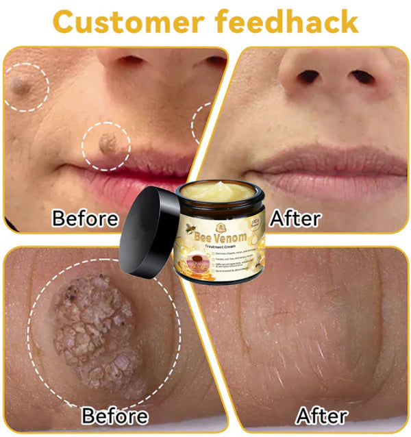 🐝PUROSA® Bee Venom Skin Treatment Cream, Anti-aging, Hydrating, Skin Repair, Even Tone, Acne and Dark Spot Treatment, Wart and Mole Removal, Psoriasis Relief