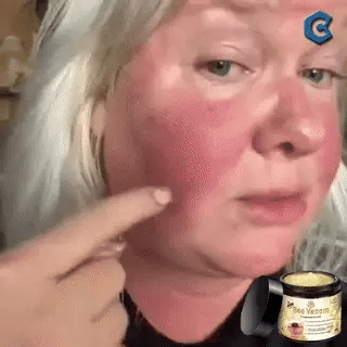 🐝PUROSA® Bee Venom Skin Treatment Cream, Anti-aging, Hydrating, Skin Repair, Even Tone, Acne and Dark Spot Treatment, Wart and Mole Removal, Psoriasis Relief