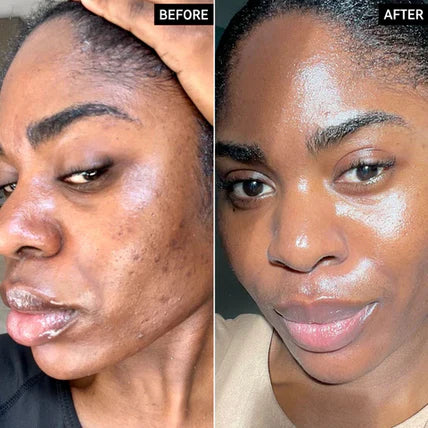 🔥Limited Time Offer🔥Tranexamic Acid Cream for Face &amp; Body