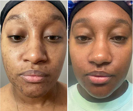 🔥Limited Time Offer🔥Tranexamic Acid Cream for Face &amp; Body